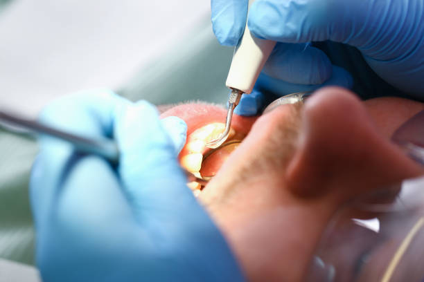 Best Dental Abscess Treatment in Four Corners, TX