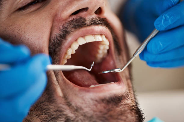 Best Dental Abscess Treatment in Four Corners, TX